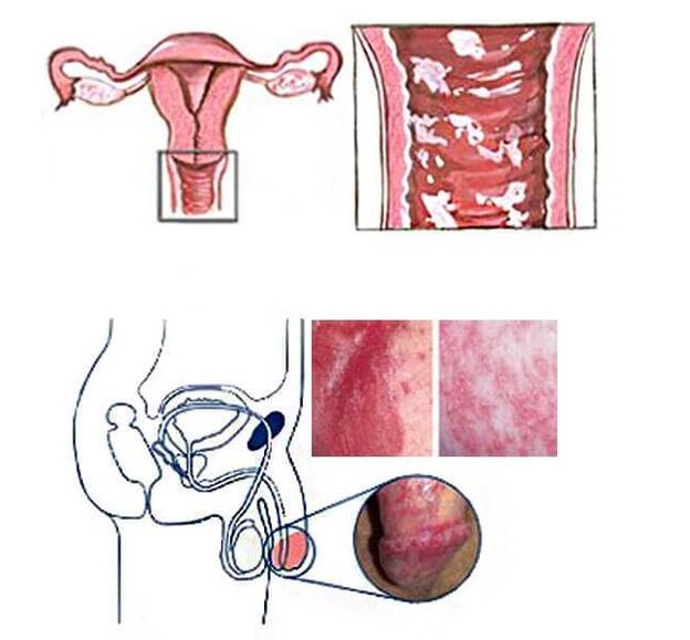 female and male genital candidiasis as a cause of pathological discharge